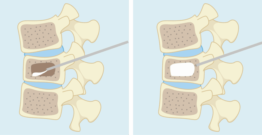 背痛別輕忽 　當心骨質疏鬆正在掏空你的骨骼