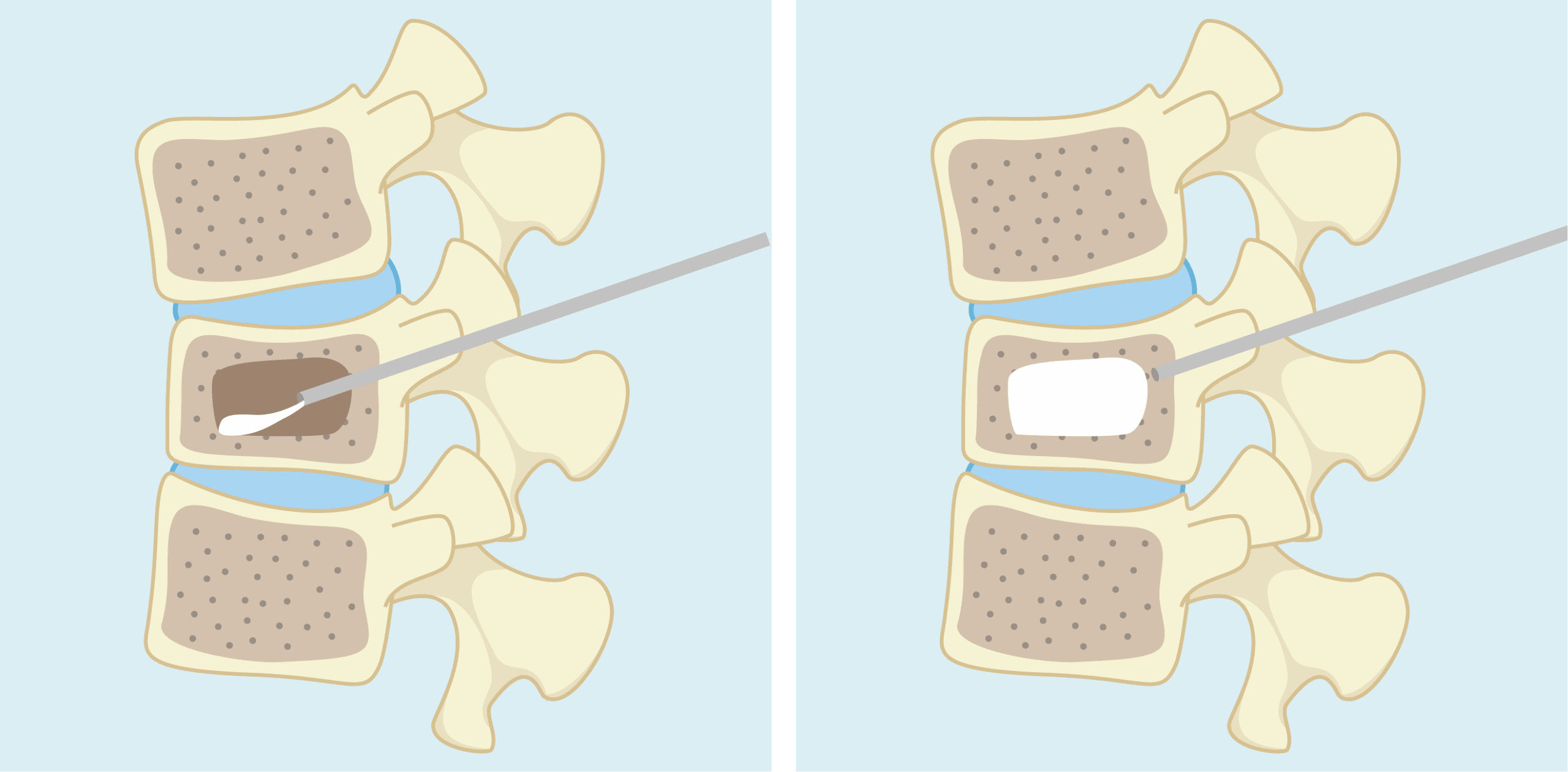 背痛別輕忽 當心骨質疏鬆正在掏空你的骨骼 背痛別輕忽 當心骨質疏鬆正在掏空你的骨骼